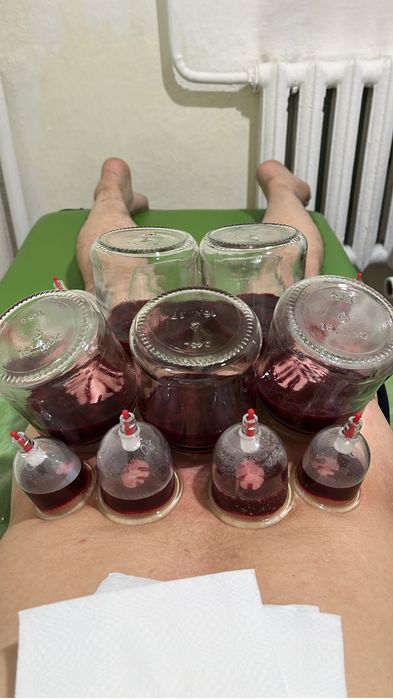 Хиджама и шертпе на выезд в городе Алматы