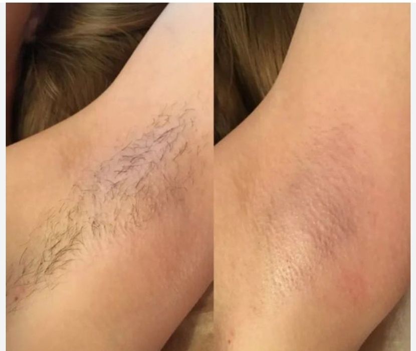 Услуга депиляции качественно и дёшова.