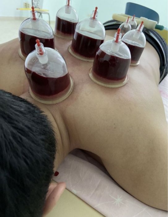 Хиджама. Кровопускание. Шертпе