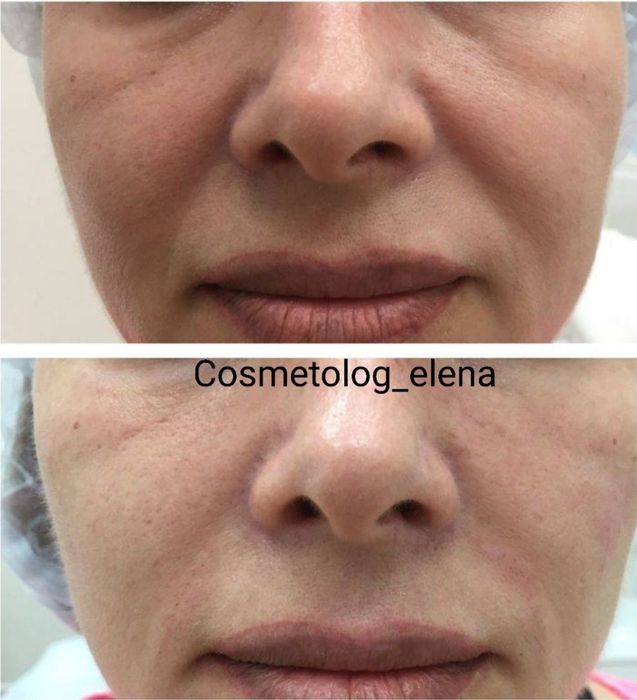 Гиалуроновая кислота отзывы фото до после Гиалуроновая кислота отзывы фото до после