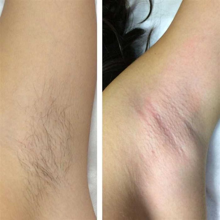 Шугаринг Воск (женский)