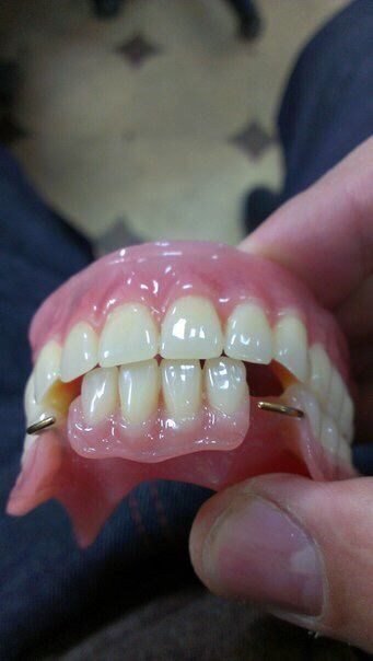 Сьемные зубные протезы