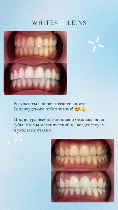 Отбеливание зубов. Готовый бизнес