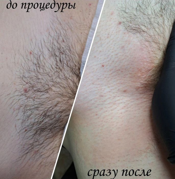 Депиляция епилатсия еркалар ва аёлар ун