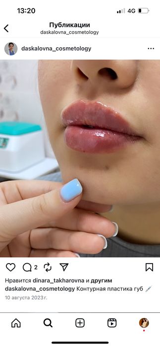 Увеличение губ 25000тг