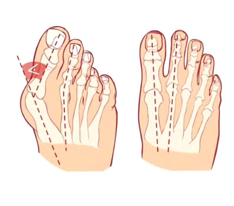 ТОП Цена Ортеза Шина за изпъкнали кокалчета Халгус Вагус Бунион