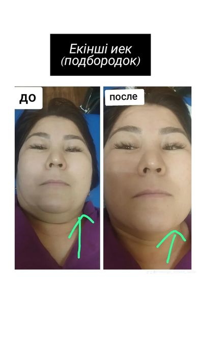 Емдік сауықтыру массажы