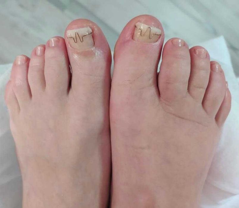 Подолог на выезд — лечение ногтей и стоп у вас дома (Алматы)