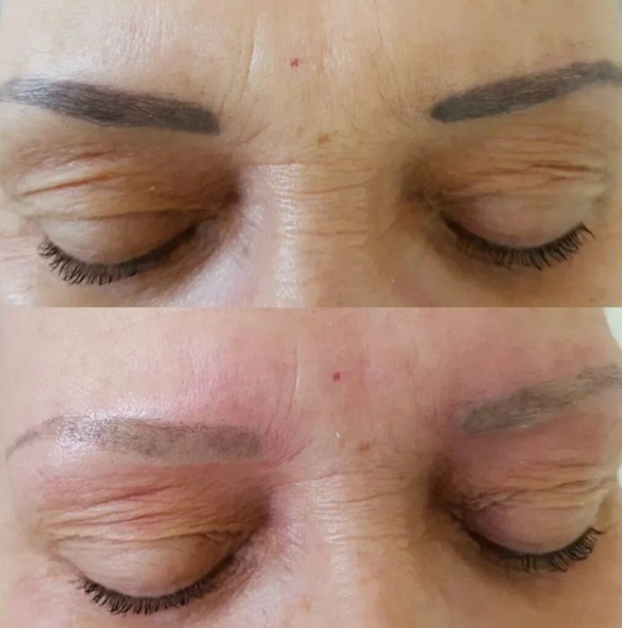 Удаление лазером тату от 5000