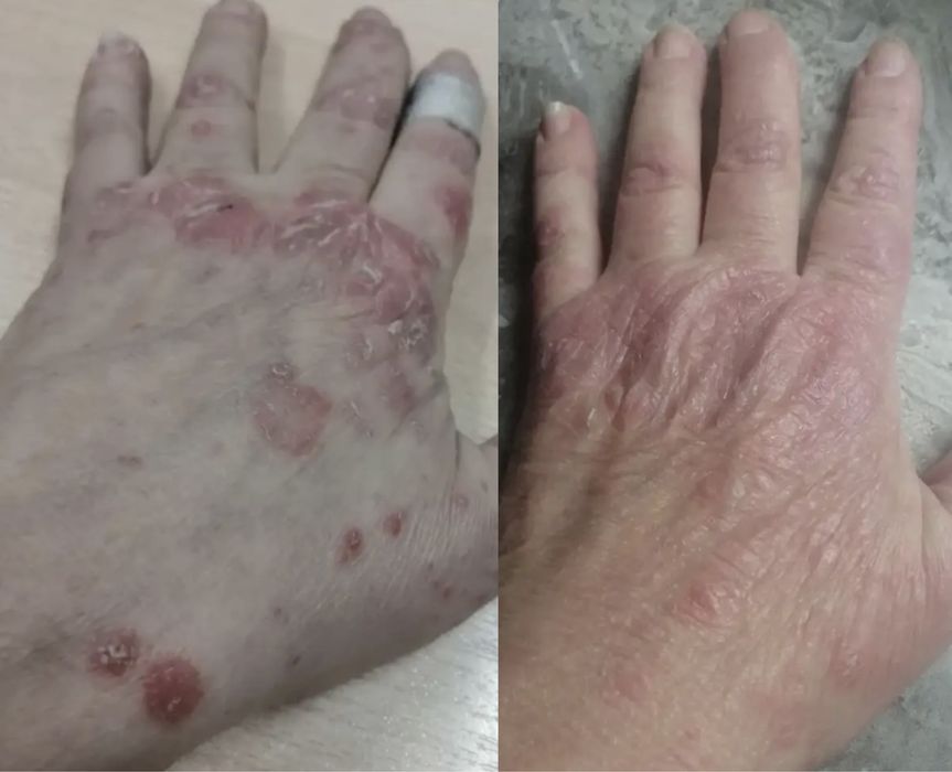 311 нм лампа  (UVB- Philips) витилиго, псориаз даволовчи лампа