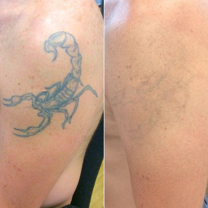 Удаление татуажа и татуировок лазером и ремувером