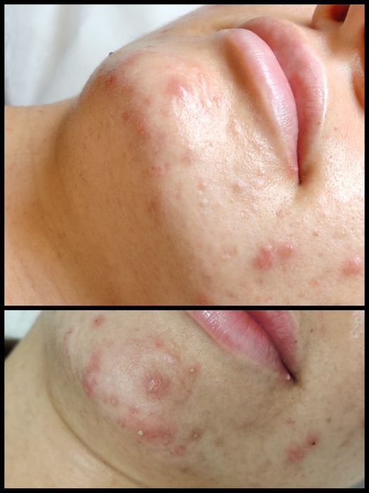 DOAR FEMEI!!! Epilat FEMEI cu ceara de unica folosința,Ep. Definitiva