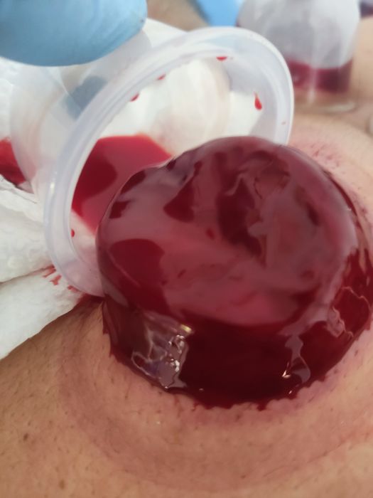 Malakali shifokor uyingizga borib yoki klinikamizda Xijoma qilamiz.