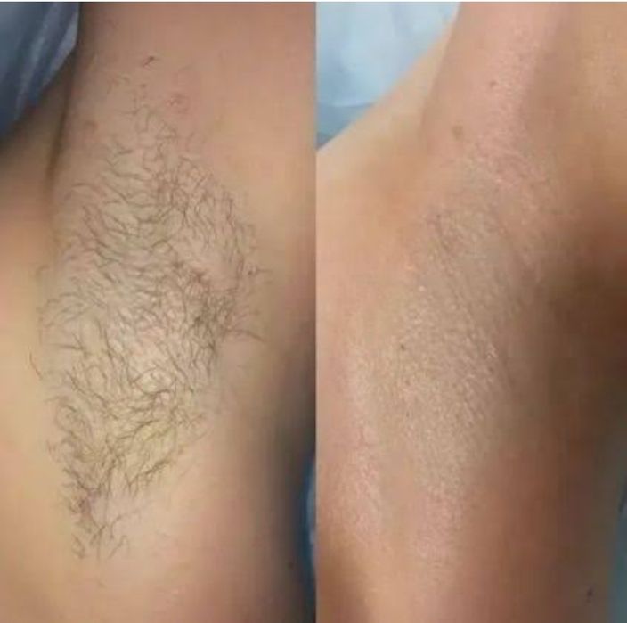 Шугаринг для мужчин и женщин