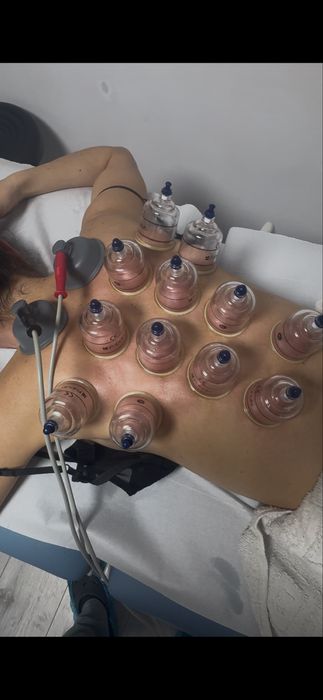 Recuperare Neurologică, Chiropractica,Acupunctură, Cupping( Ventuze)