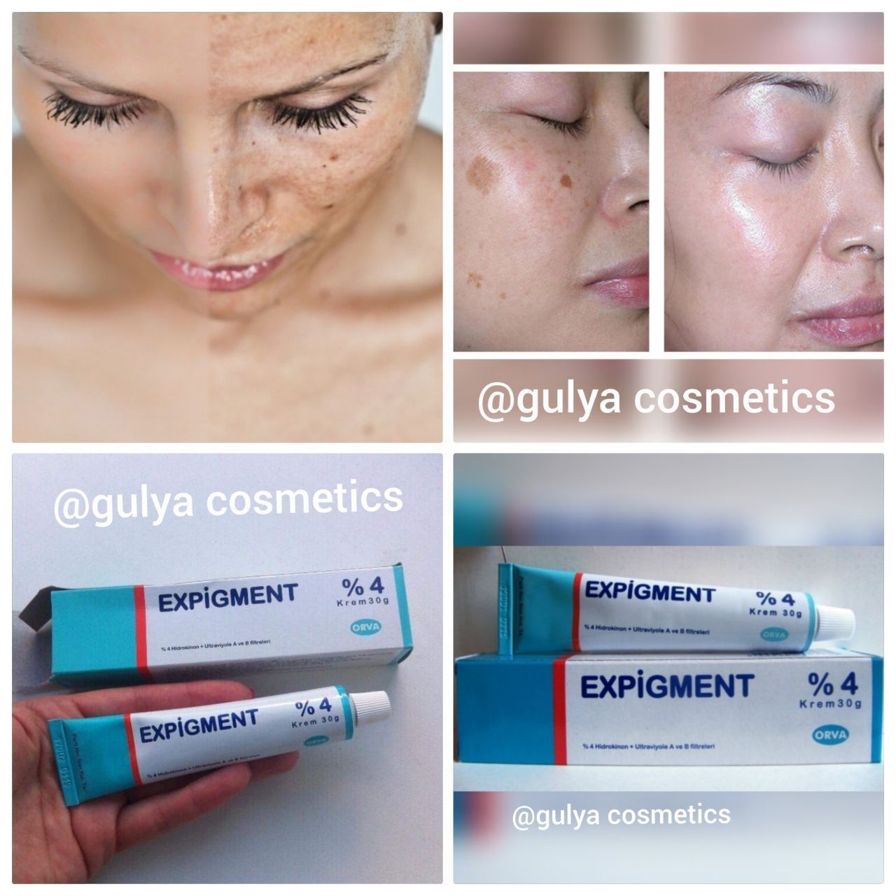 Крем expigment 4 инструкция на русском. Экспигмент крем. Крем expigment 4 инструкция на русском языке. Догларни Кетказувчи крем. Экспигмент крем фото.