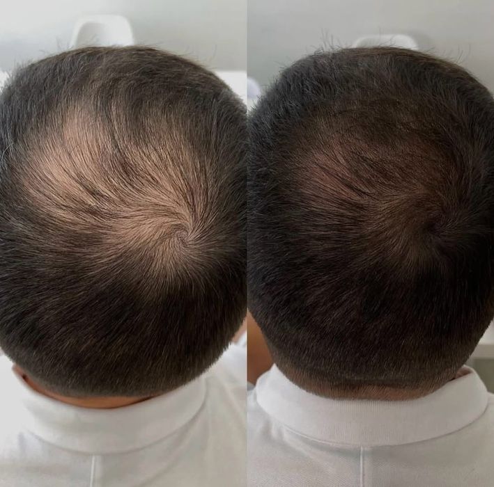 Трихопедментация головы