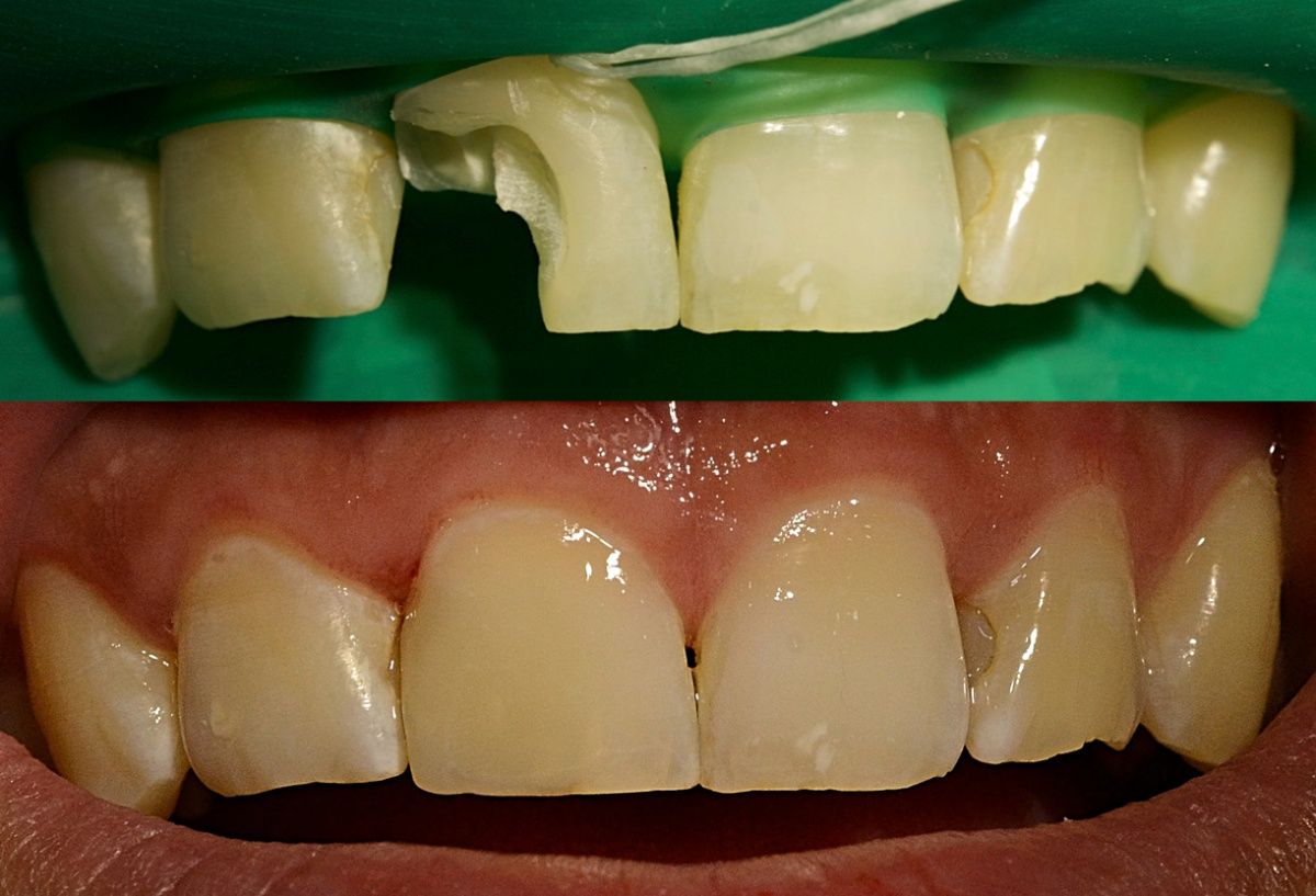стоматология наращивание зубов