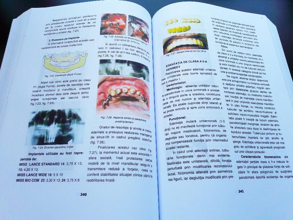 Tratat de Protetica Dentara - Norina Forna 2011 Vol. I + Vol. II NOU