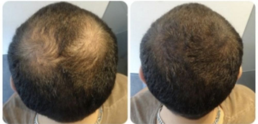 Rinoplastie, mărire buze, micropigmentare