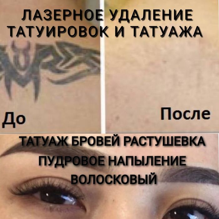Татуаж бровей. Лазерное удаление татуировок и татуажа бровей недорого!