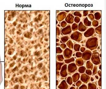 Денситометрия - анализ плотности костной ткани против остеопороза
