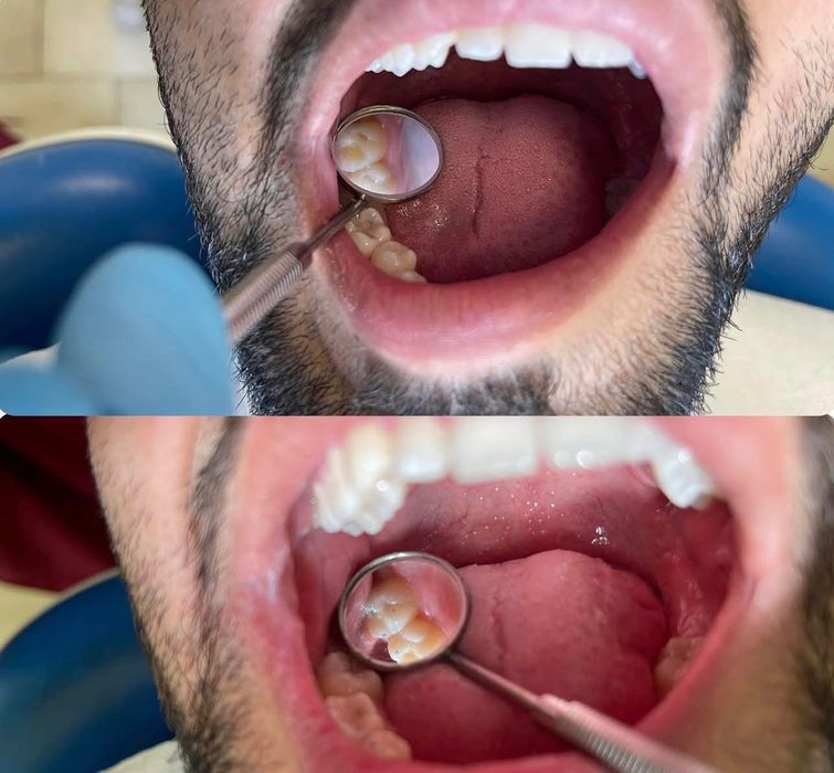 безплатно стоматологично лечение за пациенти със спонтанна болка
