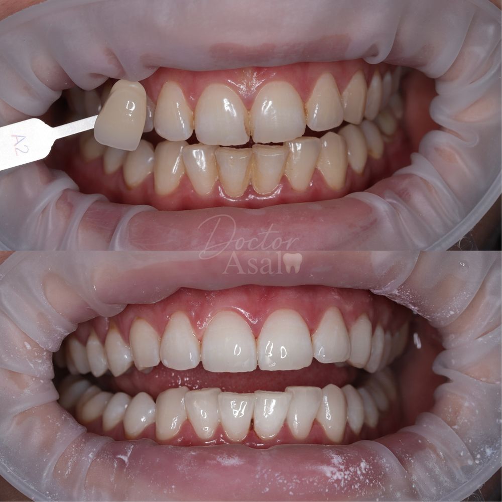 Отбеливание зубов системой Amazing White Premium