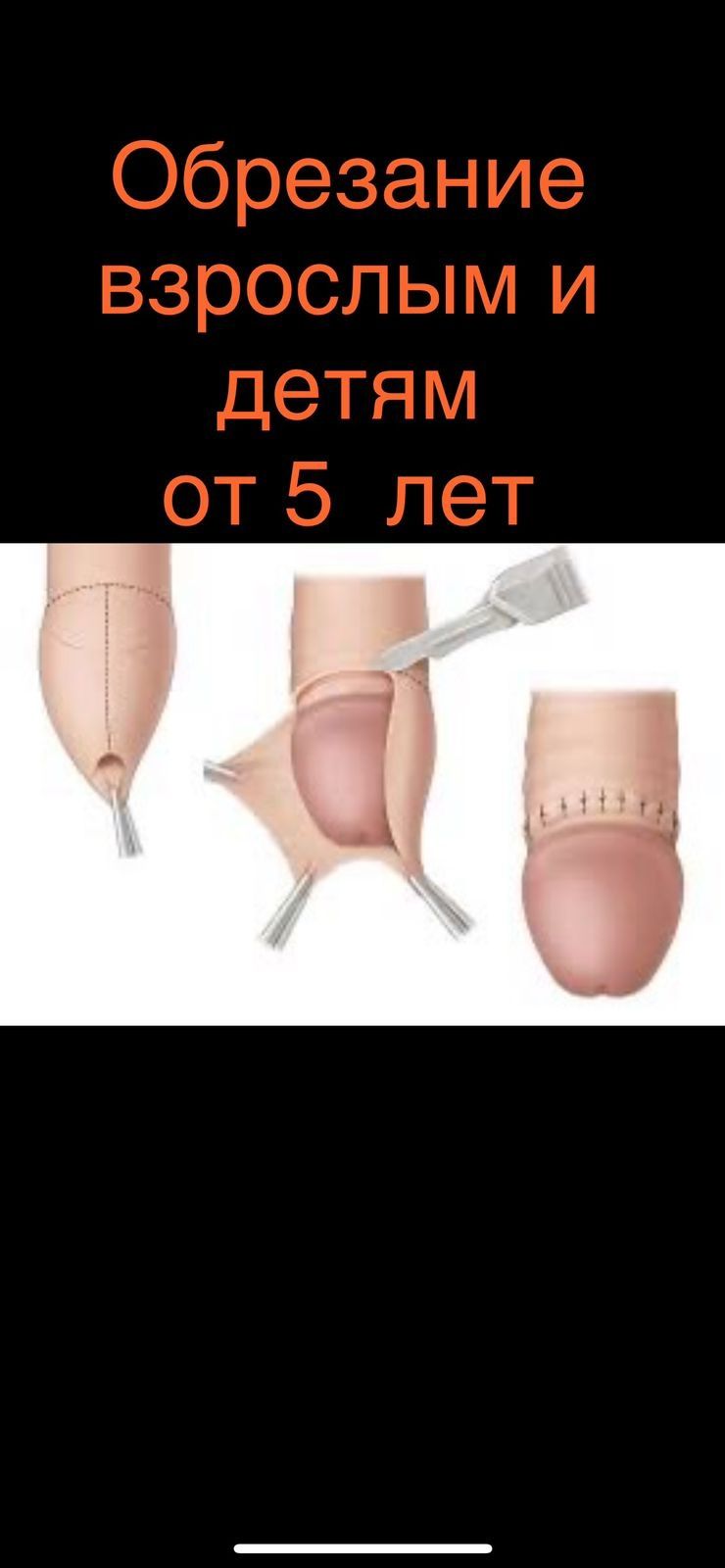Сүндетке отырғызу(обрезание) Врач хирург г. Шымкент