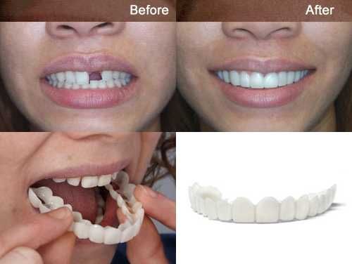 Fatete/Proteze Dentare Universale