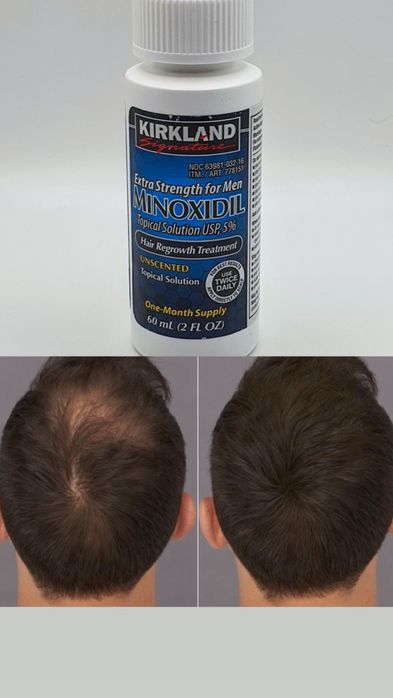 Minxidil 5% original nou