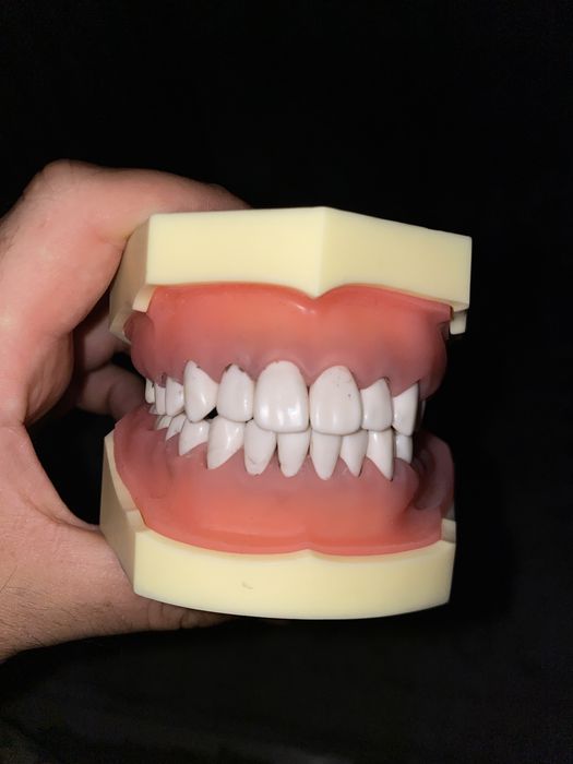 Arcadă dentară cu boală parodontală și tartru