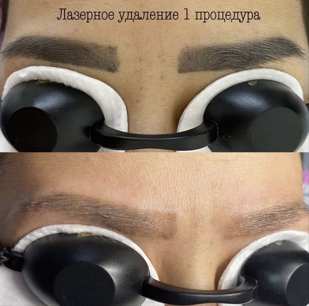 Удаление тату и татуажа