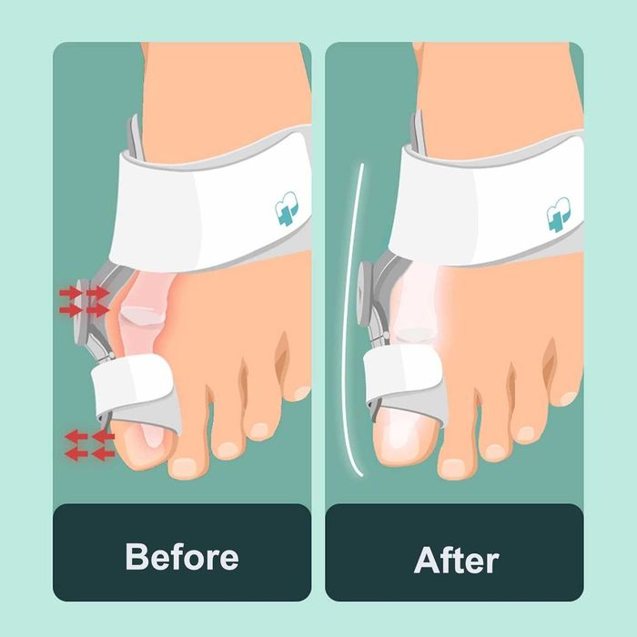 Set 2 Orteze corectoare Hallux Valgus si 1 expander pentru monturi