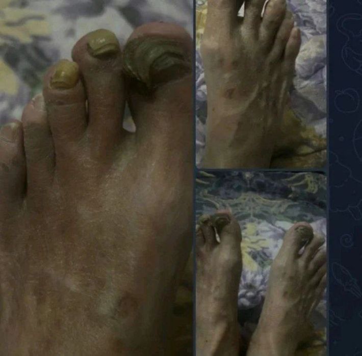 педикюр лечебный подолог на дому !