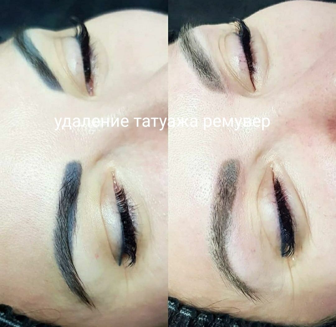 Удаление татуажа татуировки ремувер лазер брови губы стрелки