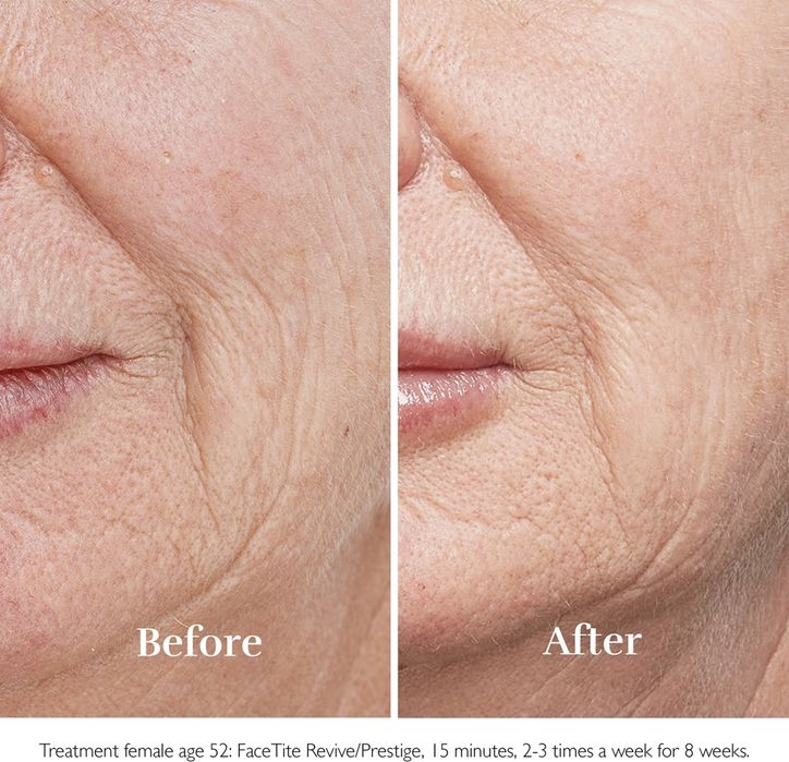 SILK'N FaceTite HT Уред за изглаждане на бръчките и стягане на кожата