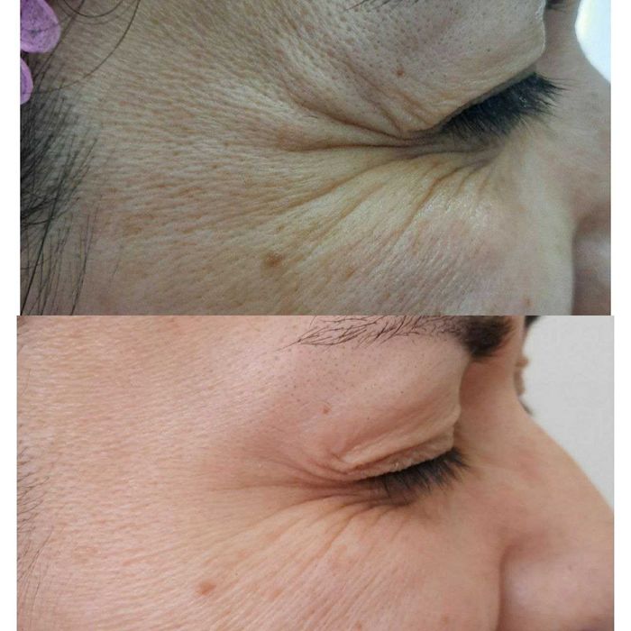 Ботокс от морщин в Ташкенте. Убираем морщины без операций.