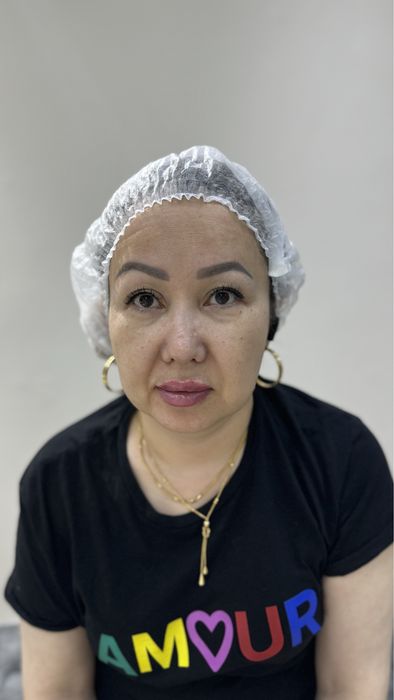 Броулифтинг , операционная блефаропластика , увеличение оуб