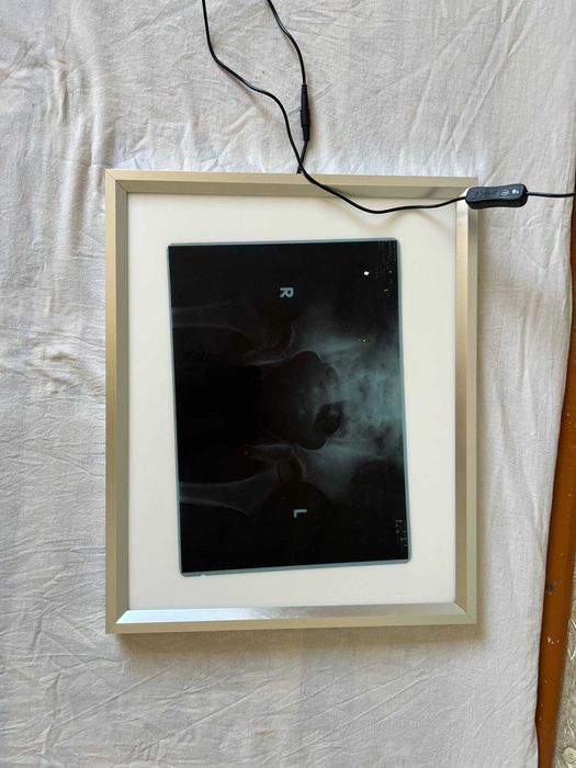 !Новый! Медицинский негатоскоп Nеgаtoskop rentgen doska рентген доска