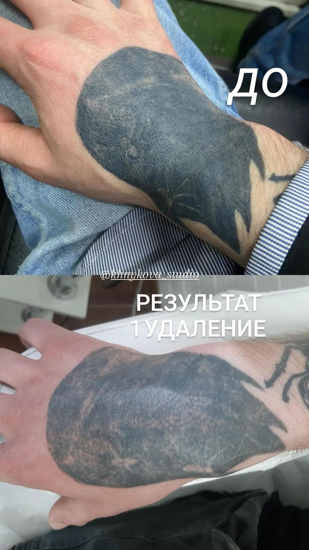 Удаление тату и татуажа