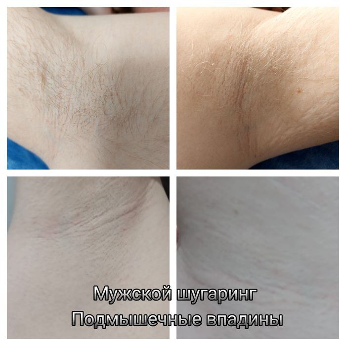 БИКИНИ БЕЗ БОЛИ!! Шугаринг, Эластомерная депиляция,женс/муж