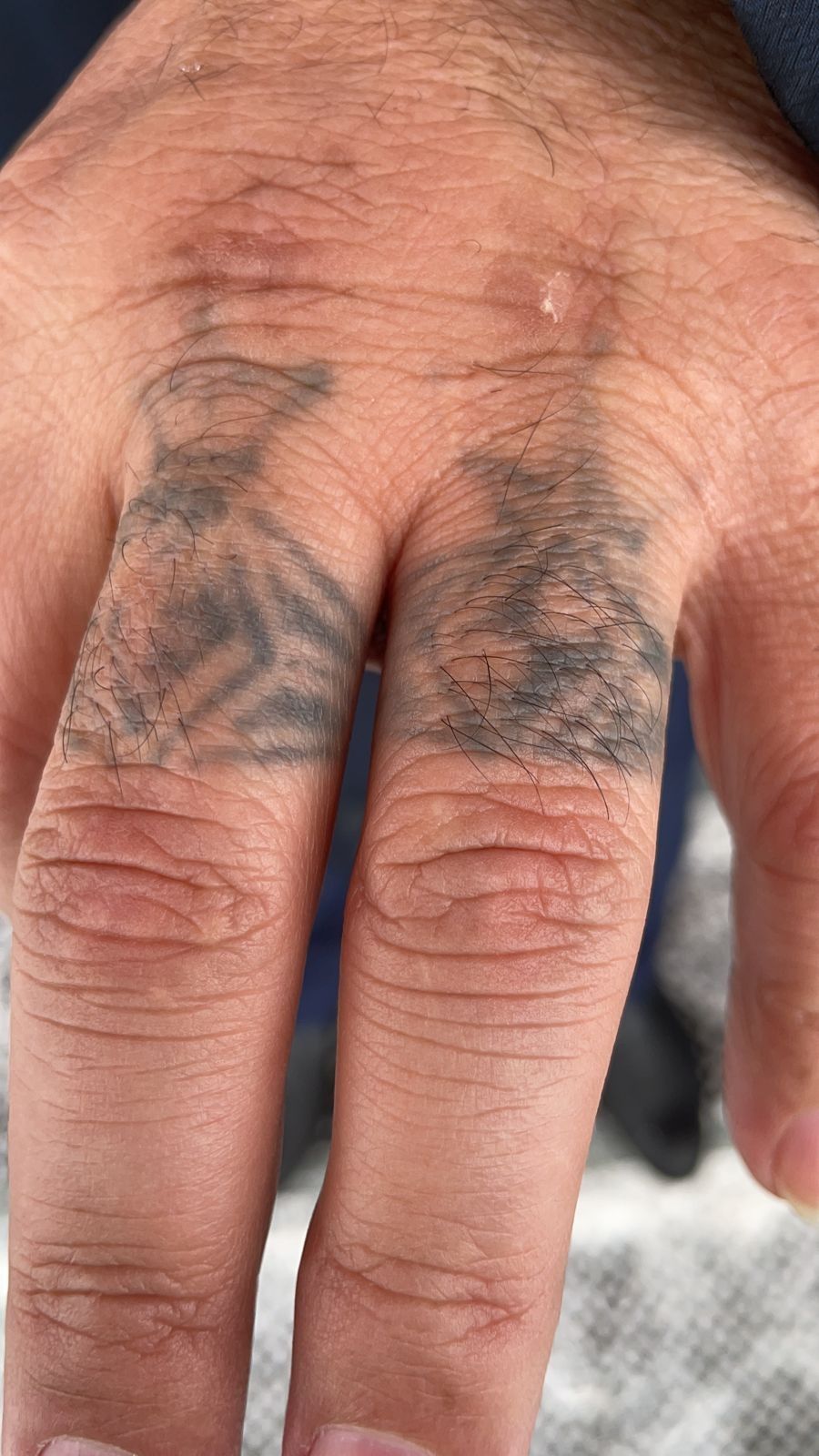 Удаление татуажа от 4000тг и татуировок лазером с 30%