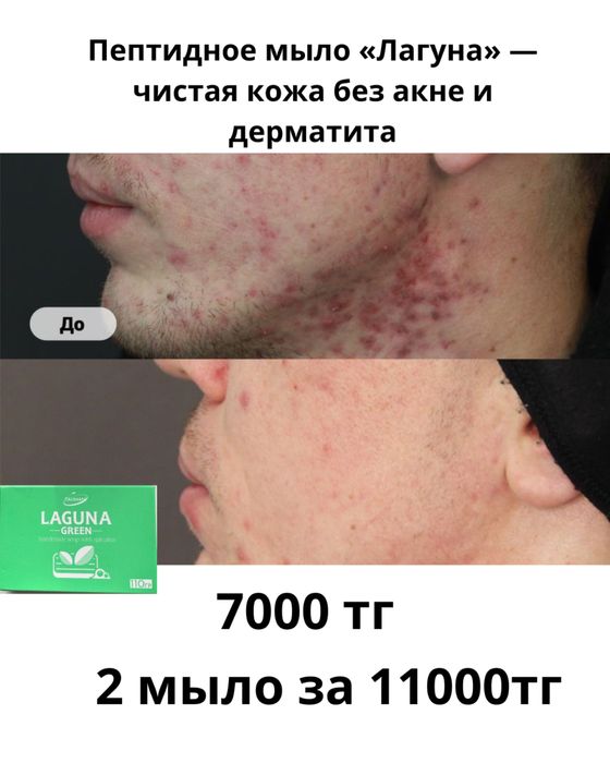 Средство от акне