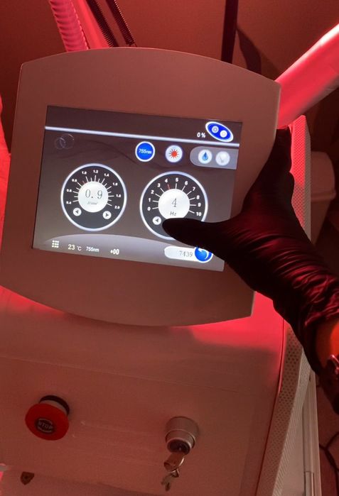 Laser NdYag indepartare tatuaj