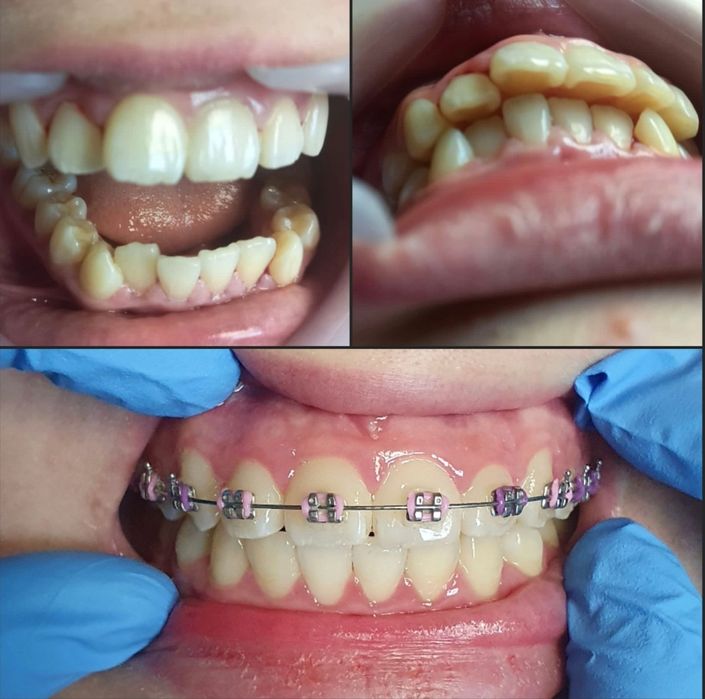 Брекет системы по АКЦИИ (ортодонтическое лечение)