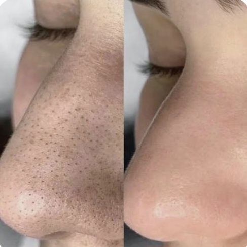 Yuzni chishtka qilish. Глубокая чистка лица