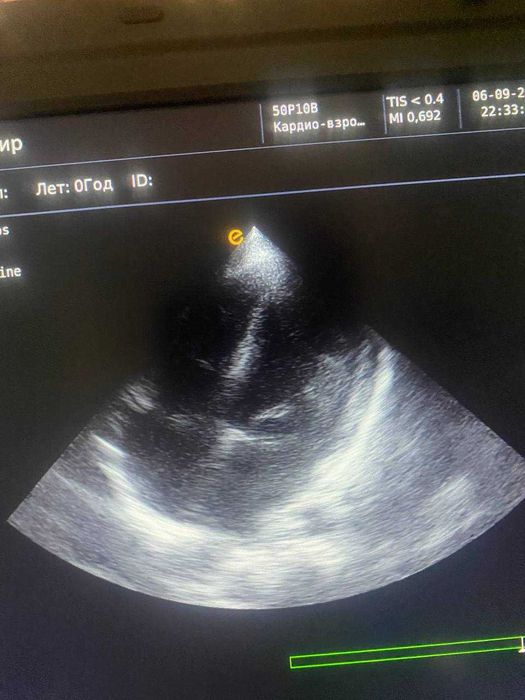 Портативный УЗИ аппарат EMP G30