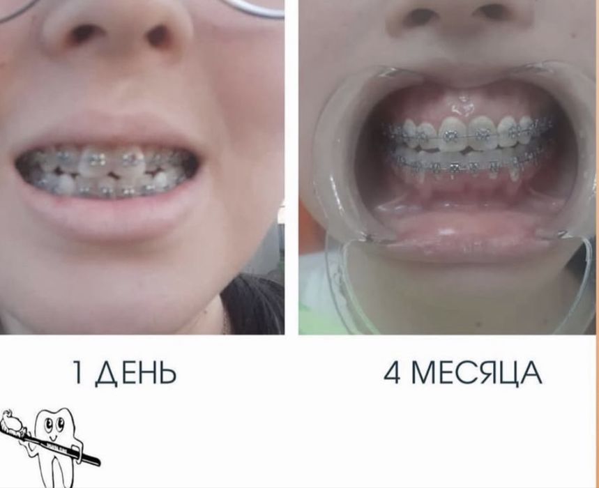 Брекеты металлические НА ОБЕ ЧЕЛЮСТИ