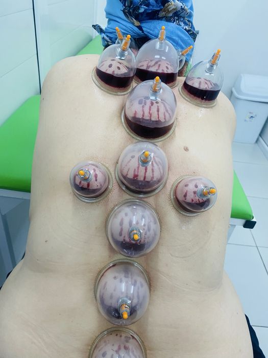 Хиджама , очищение лечение